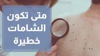 الشامات متى تكون علامة خطر؟